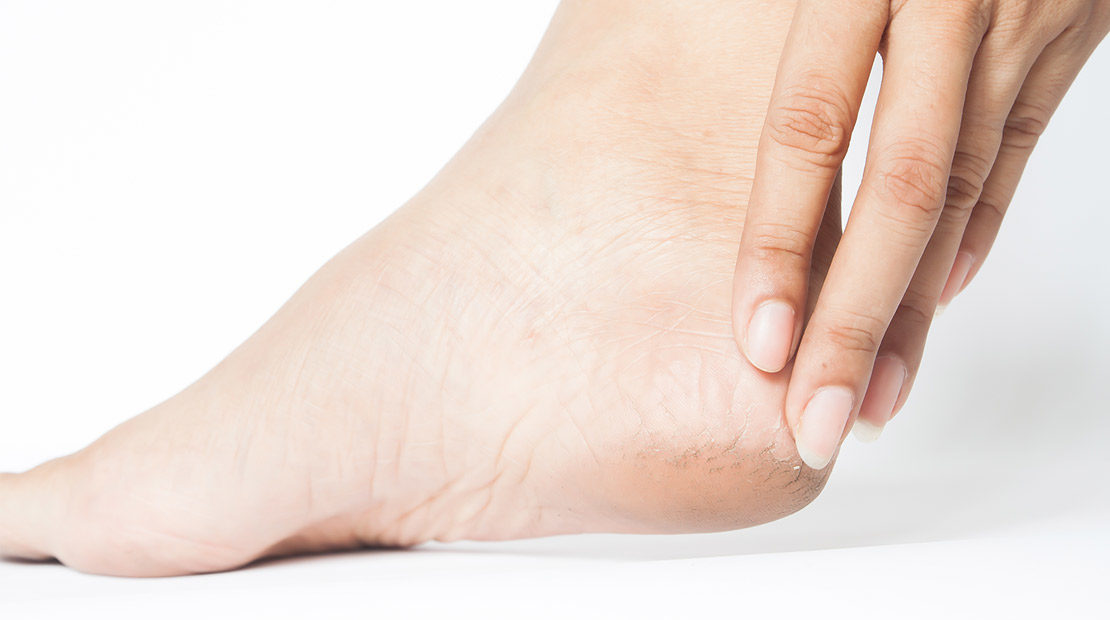 පැලුණු කකුල් සුව කර ගන්න හොඳම සත්කාර මෙන්න