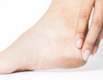 පැලුණු කකුල් සුව කර ගන්න හොඳම සත්කාර මෙන්න